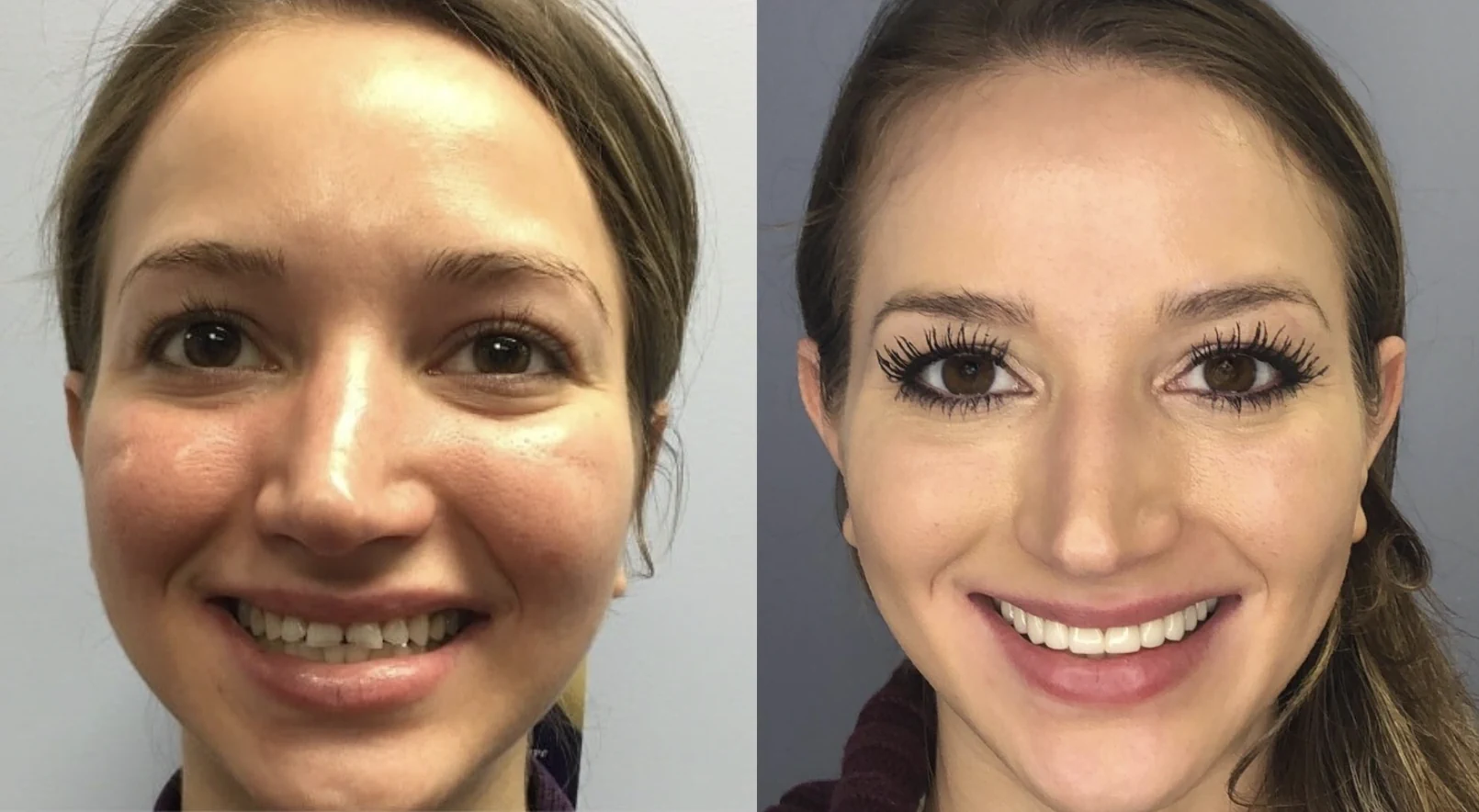 Before and after metal free implants