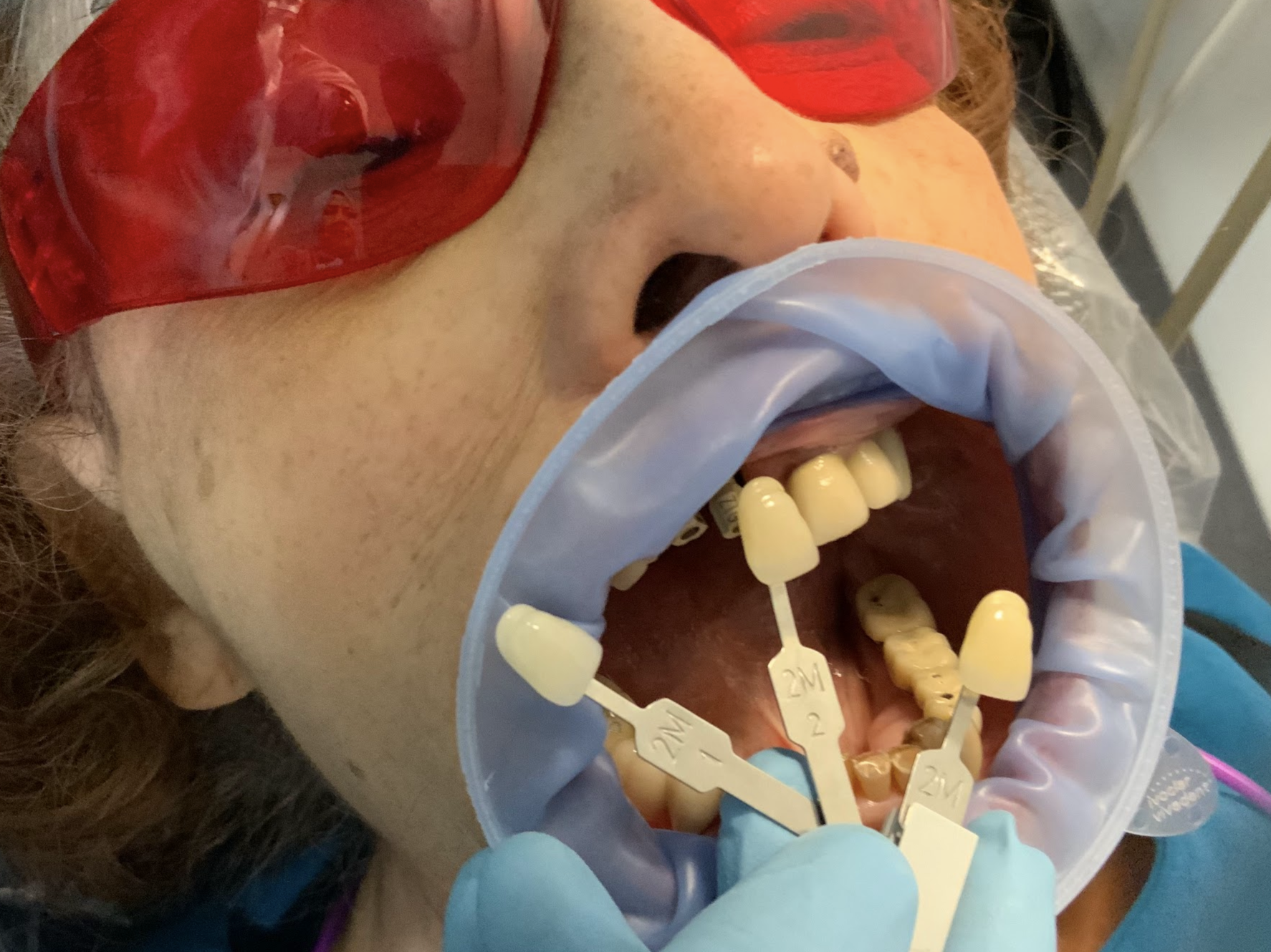 Metal free dental implants